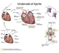 Dissekeringsduk hjerte